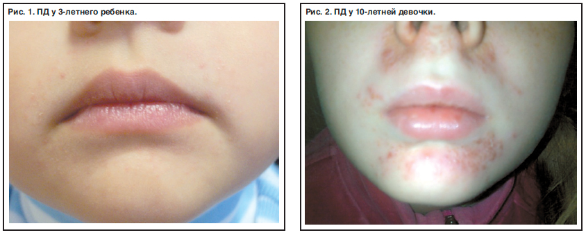 Периоральный дерматит у детей - Педиатрия №01 2014 - Consilium Medicum