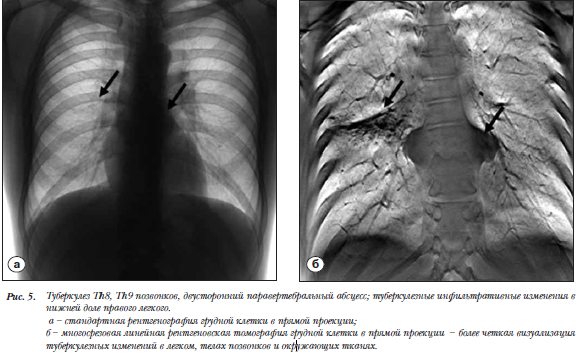 Диагностика и лечение туберкулеза позвоночника в Москве | Добромед