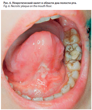 Стоматит слизистой оболочки полости рта