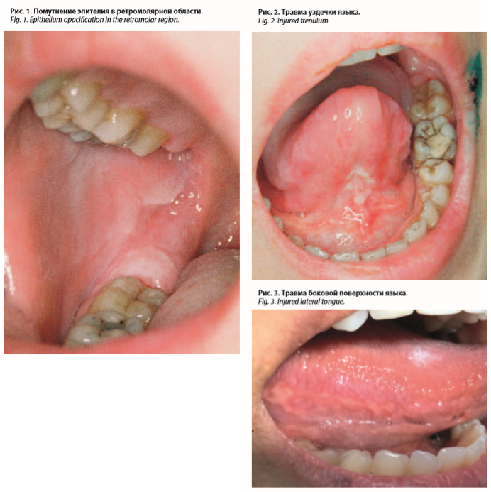 Рак губы: симптомы и лечение