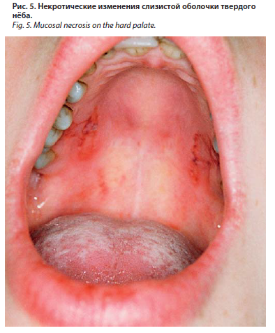 Уход за полостью рта во время химиотерапии