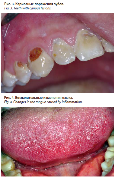 Основные заболевания слизистой оболочки полости рта