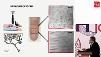 Телемониторинг капиллярного кровотока в коже человека. Новые возможности и перспективы